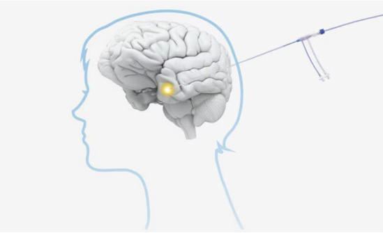 From Concept to Application: The Impact of Rapid Prototyping on Neurological Device Innovation